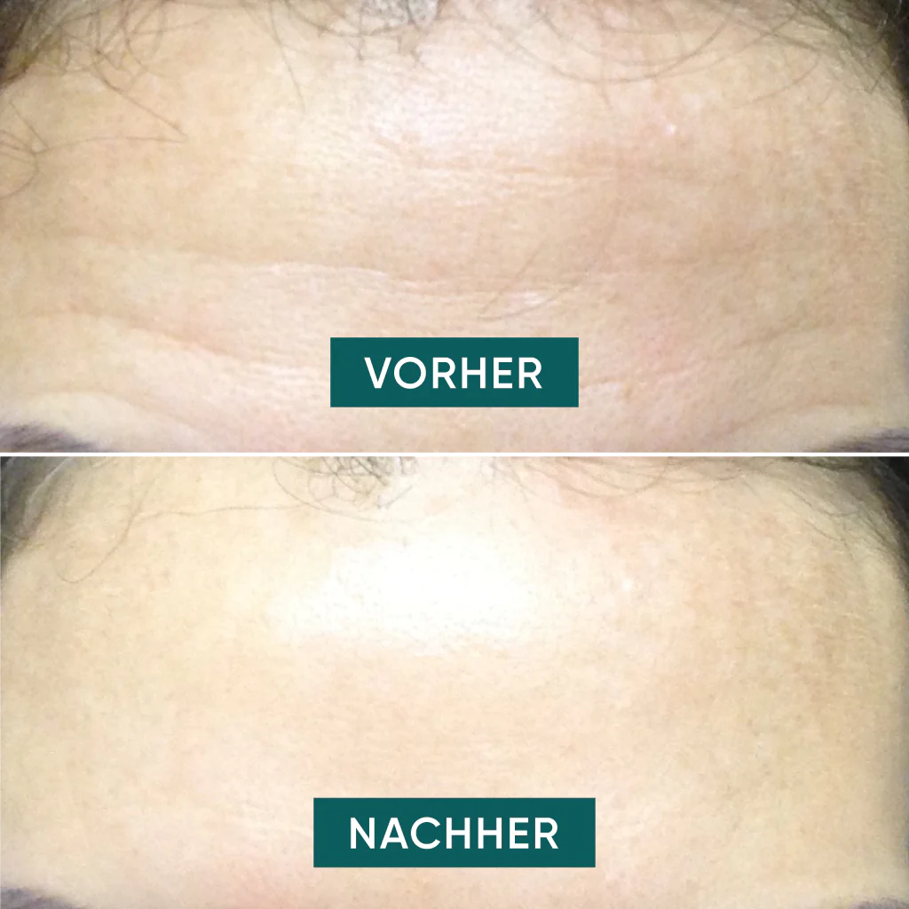 APRICOT silikoonist kortsuplaaster hüaluroonhappega otsmikule “Fantastic Forehead”  30x korduvkasutatav